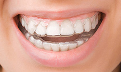 invisalign