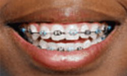 metal braces